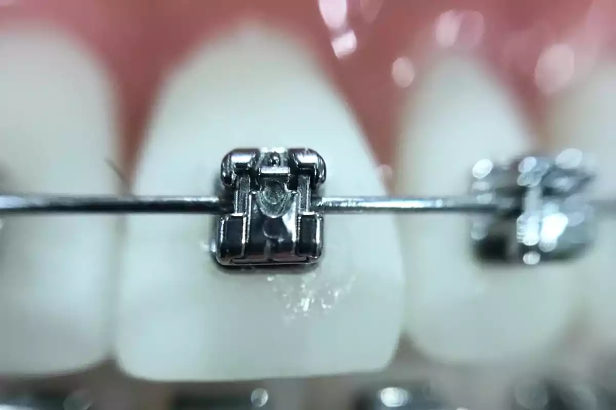 Detall d’una dent amb un bracket d’ortodòncia metàl·lic i filferro ajustat